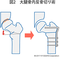 手術イコール人工股関節手術なのですか？ほかにも選択肢があるのでしょうか？