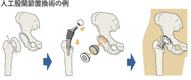 人工股関節の耐用年数が延びたとのことですが、どういう点が進歩して延びたのでしょうか？また具体的な耐用年数はどれくらいですか？