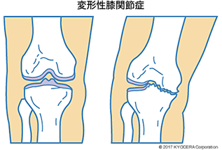 股関節に比べて複雑な動きをするのですね。代表的な疾患についてもご説明ください。