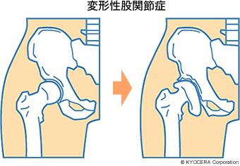 変形性股関節症