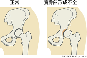 正常 寛骨臼形成不全