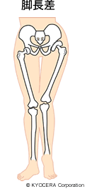 脚長差