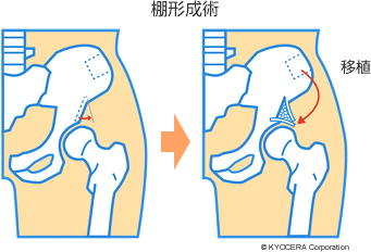 棚形成術