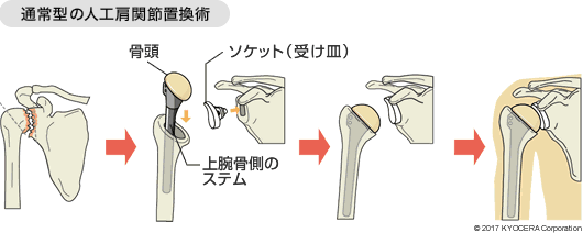 リバース型人工関節