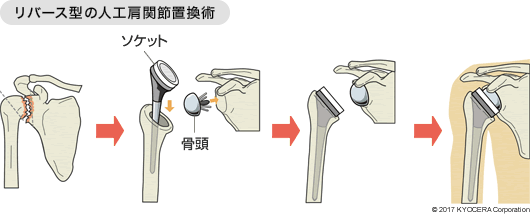 リバース型人工関節