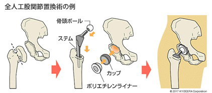 全人工股関節置換術の例