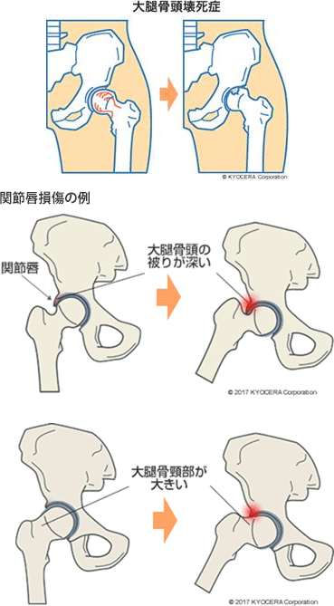 関節唇損傷の例