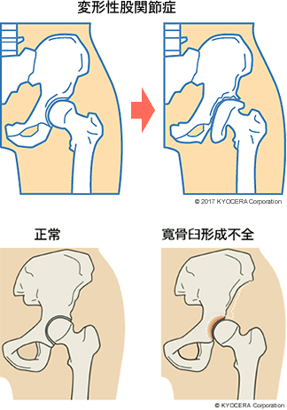 変形性股関節症