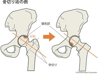 骨切り術の例