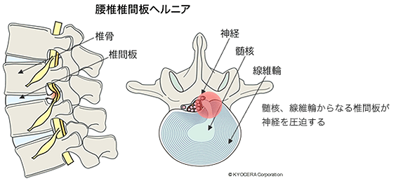 腰椎椎間板ヘルニア