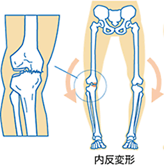 内反変形