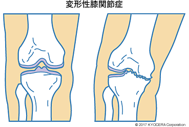 変形性膝関節症