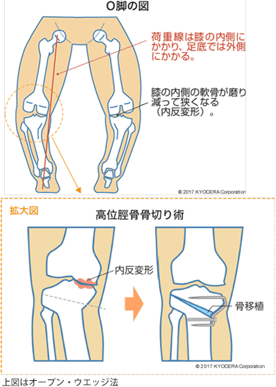 O脚の図