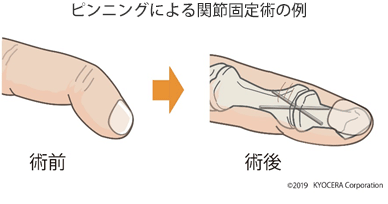 ピンニングによる関節固定術の例