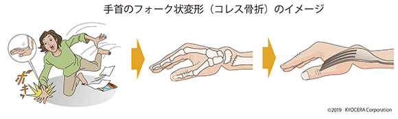 手首のフォーク状変形のイメージ