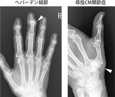 へバーデン結節 母指CM関節症