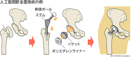 人工股関節全置換術の例