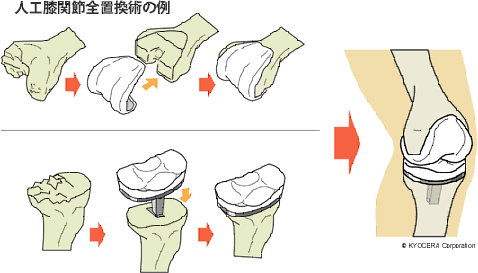 人工膝関節全置換術