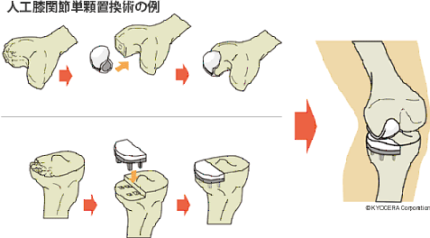 人工膝関節単顆置換術