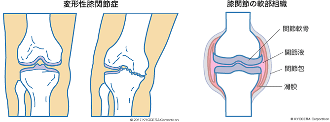 変形性膝関節症