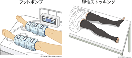 弾性ストッキングやフットポンプ