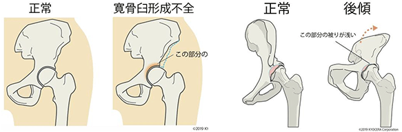 寛骨臼形成不全