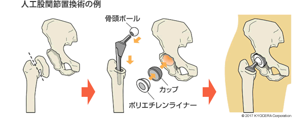 人工股関節置換術