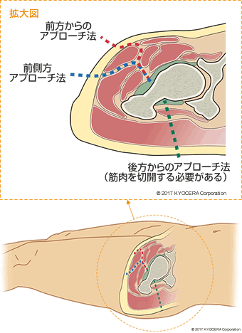 股関節に至る切開方法