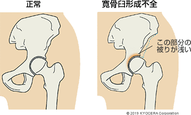 正常 寛骨臼形成不全