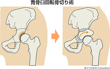 寛骨臼回転骨切り術