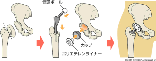 人工股関節置換術の例