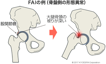 FAIの例（骨盤側の形態異常）