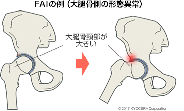 FAIの例（大腿骨側の形態異常）
