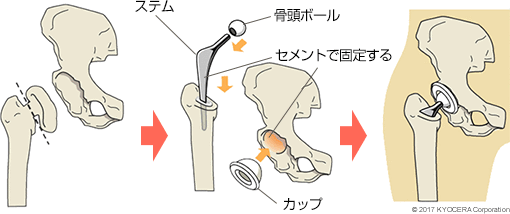 セメントタイプの人工股関節置換術の例