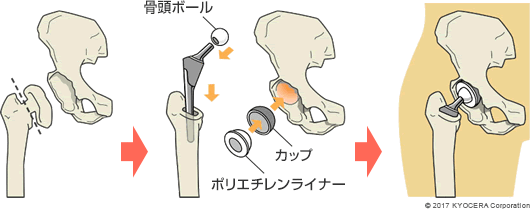 セメントレスタイプの人工股関節置換術の例