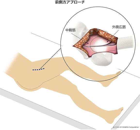 前側方アプローチ