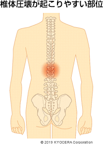 椎体圧壊が起こりやすい部位