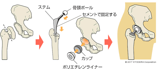 人工股関節