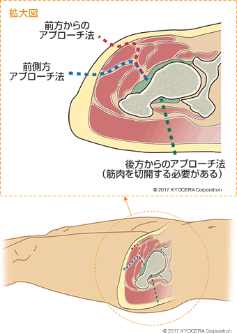 アプローチ法