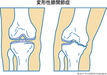 変形性膝関節症