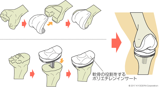 人工膝関節全置換術の例