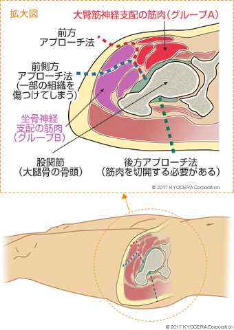 前方アプローチ法 前側方アプローチ法(一部の組織を傷つけてしまう) 股関節（大腿骨の骨頭） 後方アプローチ法(筋肉を切開する必要がある) 大臀筋神経支配の筋肉（グループA） 坐骨神経支配の筋肉（グループB）
