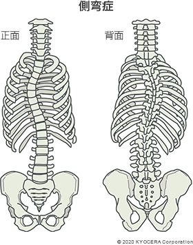 側弯症