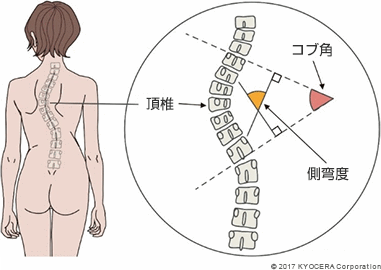 頂椎 コブ角 側弯度