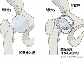 股関節外観 関節包をはがした状態 関節包 関節唇