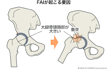 FAIが起こる要因 大腿骨頭頸部が大きい
