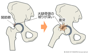 FAIが起こる要因 大腿骨頭の被りが深い