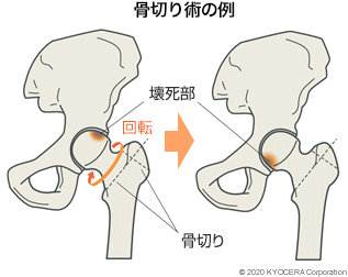 骨切り術の例