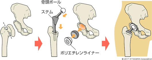 人工股関節置換術の例