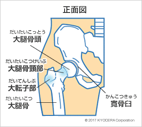 人工 骨頭 置換 術 脱臼